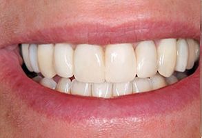 Torrance Dental Care | Extractions, Veneers and Dentures