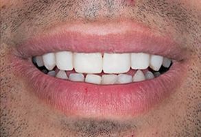 Torrance Dental Care | Dentures, Teeth Whitening and Veneers