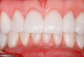 Torrance Dental Care | Periodontal Treatment, Crowns  amp  Caps and Invisalign reg 